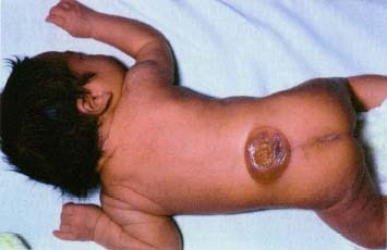 spina-bifida.jpg